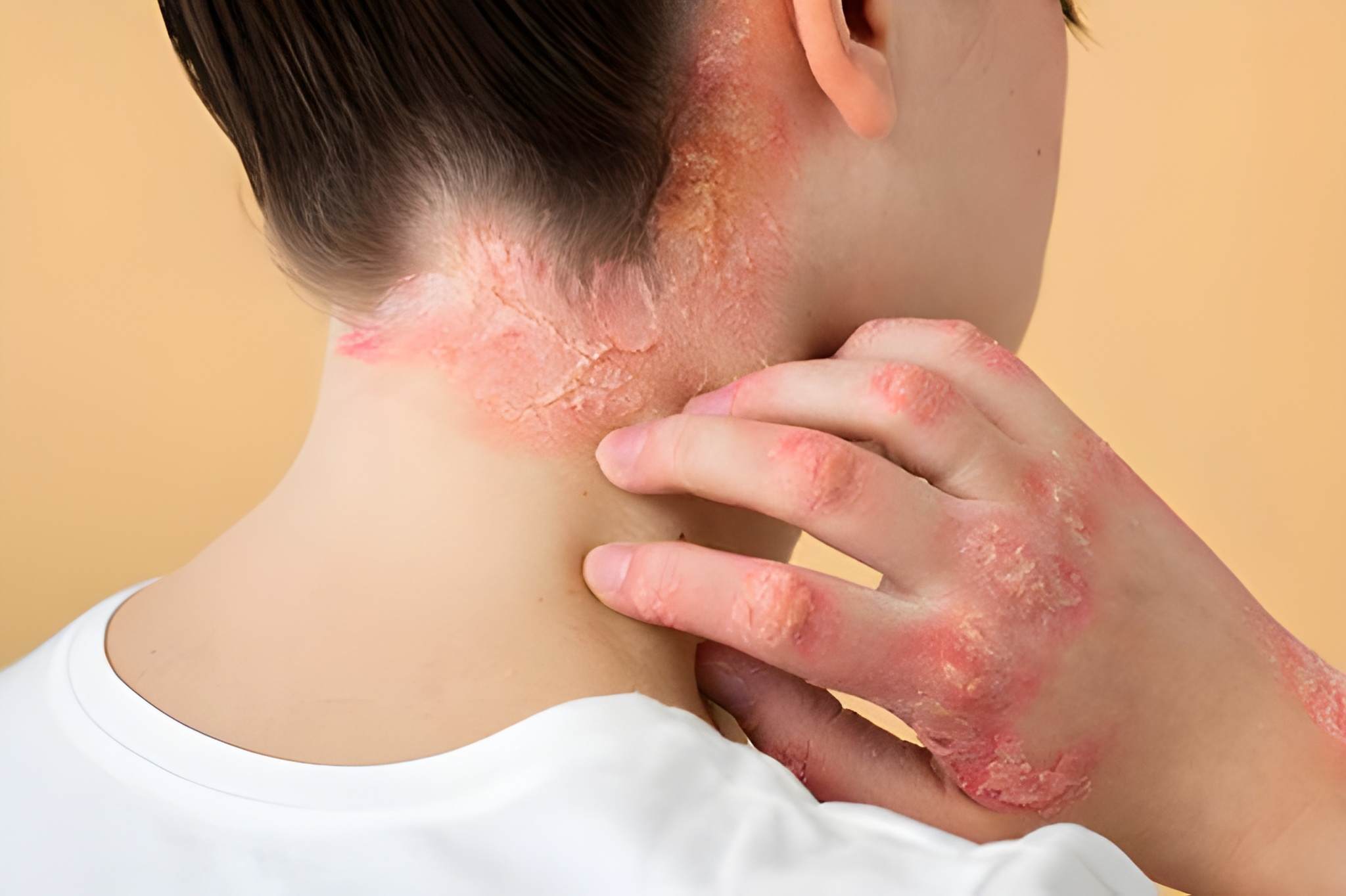 allergy