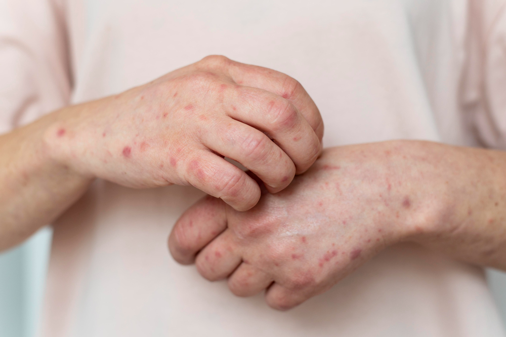 Hives