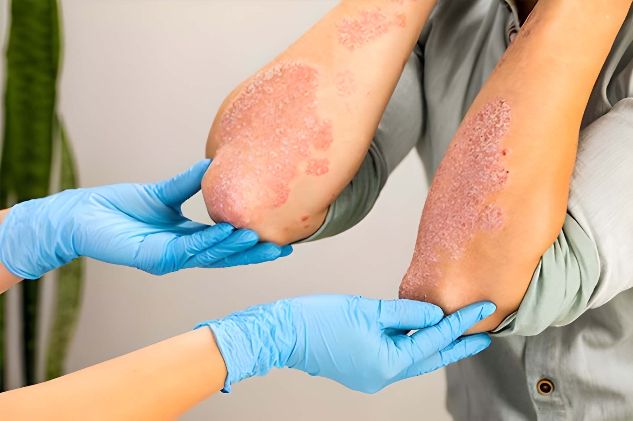 psoriasis